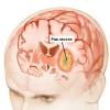 Симптомы рака мозга на ранних стадиях
