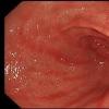Gastritis con alta acidez (Gastritis hiperácida)
