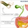 Helicobacter pylori: causes of infection, treatment regimen