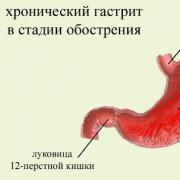 Gastrite de l'estomac: symptômes