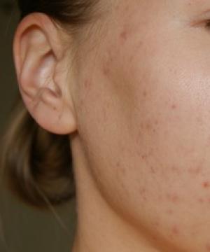 Cómo deshacerse rápidamente del acné y olvidarse de él para siempre Remedio casero para el acné en la cara rápidamente