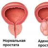 Is prostate adenoma treated without surgery?